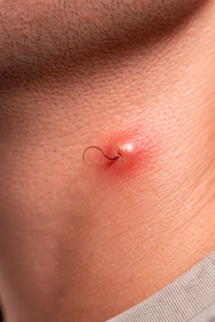 How to Fix and Heal an Ingrown Hair